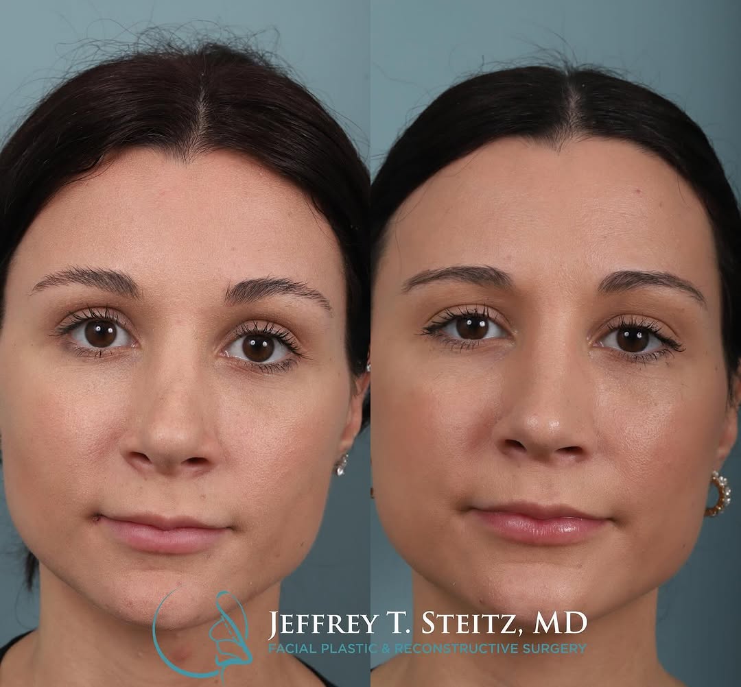 Instagram post by Dr. Jeffrey T. Steitz: This patient is 1 year out from a revision septorhinoplasty to correct an inverted V deformity and other structural issues. Swipe for all vi…