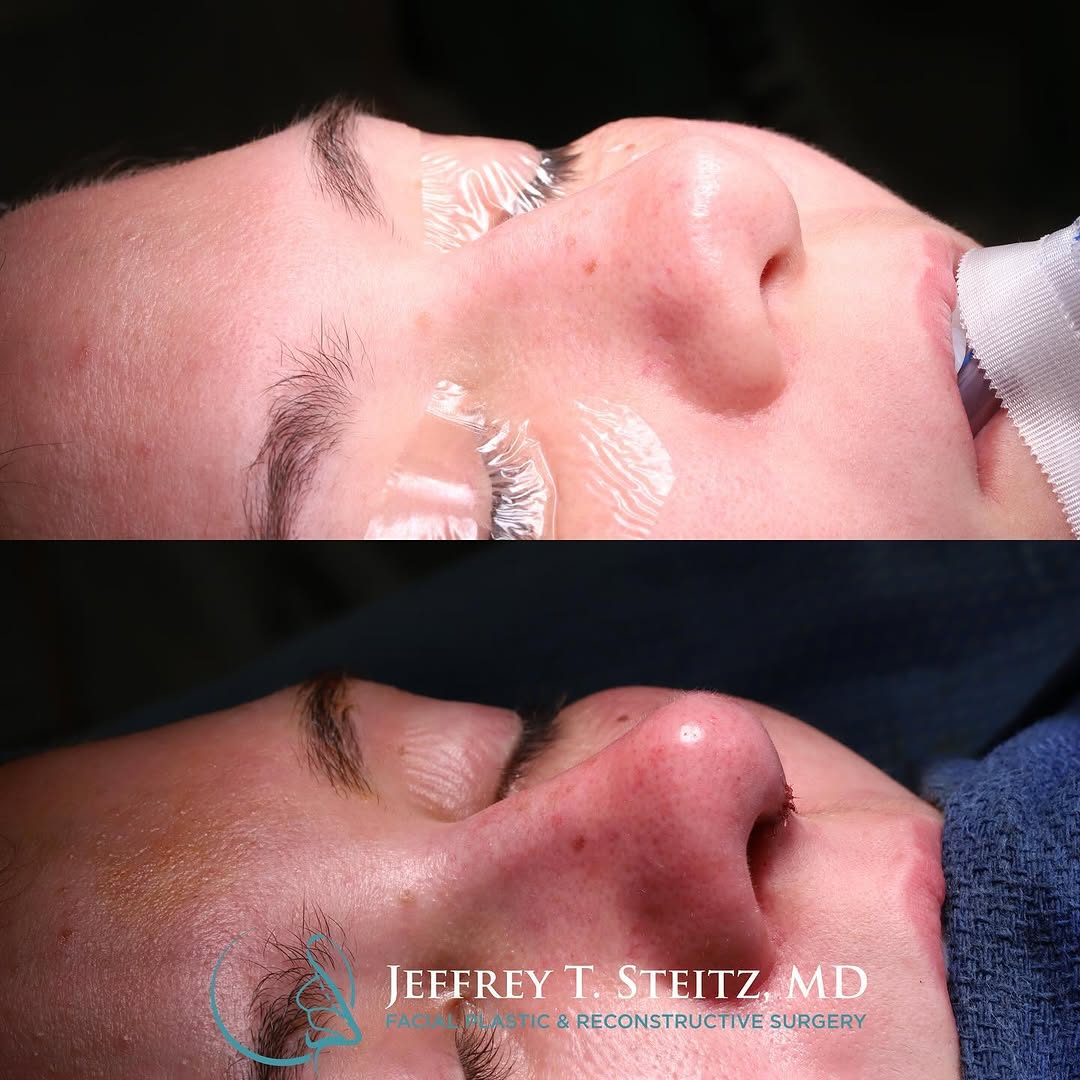 Instagram post by Dr. Jeffrey T. Steitz: Here are some intraoperative photos from a primary septorhinoplasty with rib cartilage graft. She had some previously extensive trauma that …