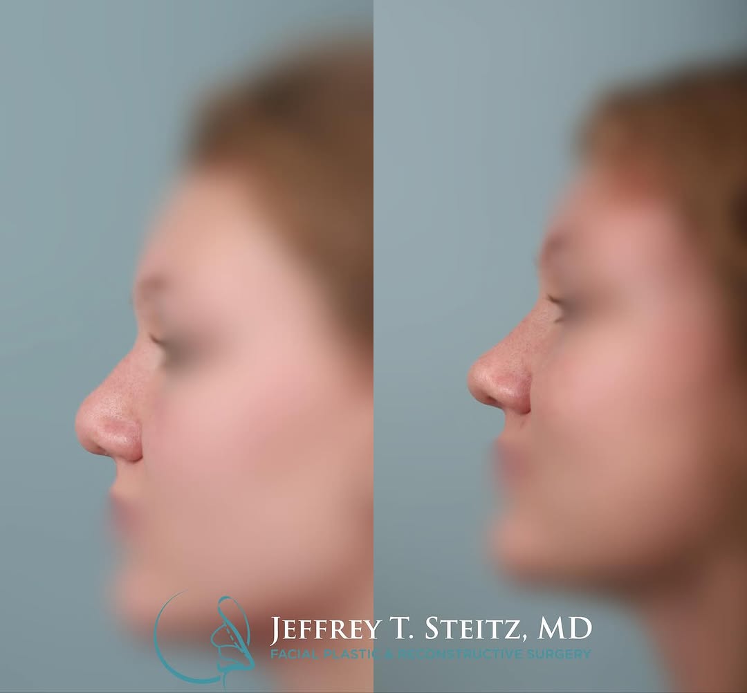Instagram post by Dr. Jeffrey T. Steitz: This is a 1 year postoperative look on a patient who had a previous nasal injury leading to a septoplasty which led to an external saddling …