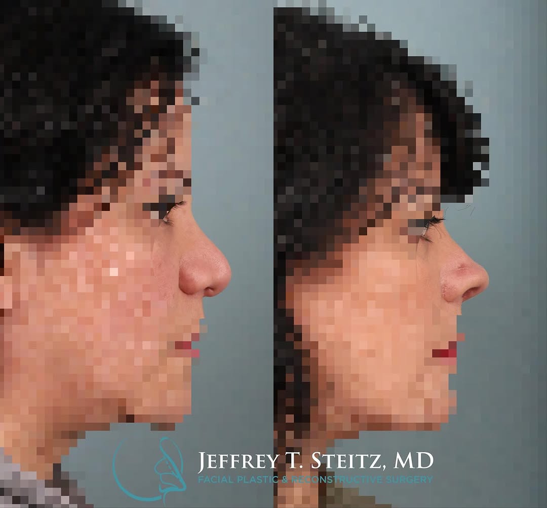 Instagram post by Dr. Jeffrey T. Steitz: I’ve gotten a lot of questions from patients lately about what makes revisions particularly difficult. Is it the number? Is it the bridge he…