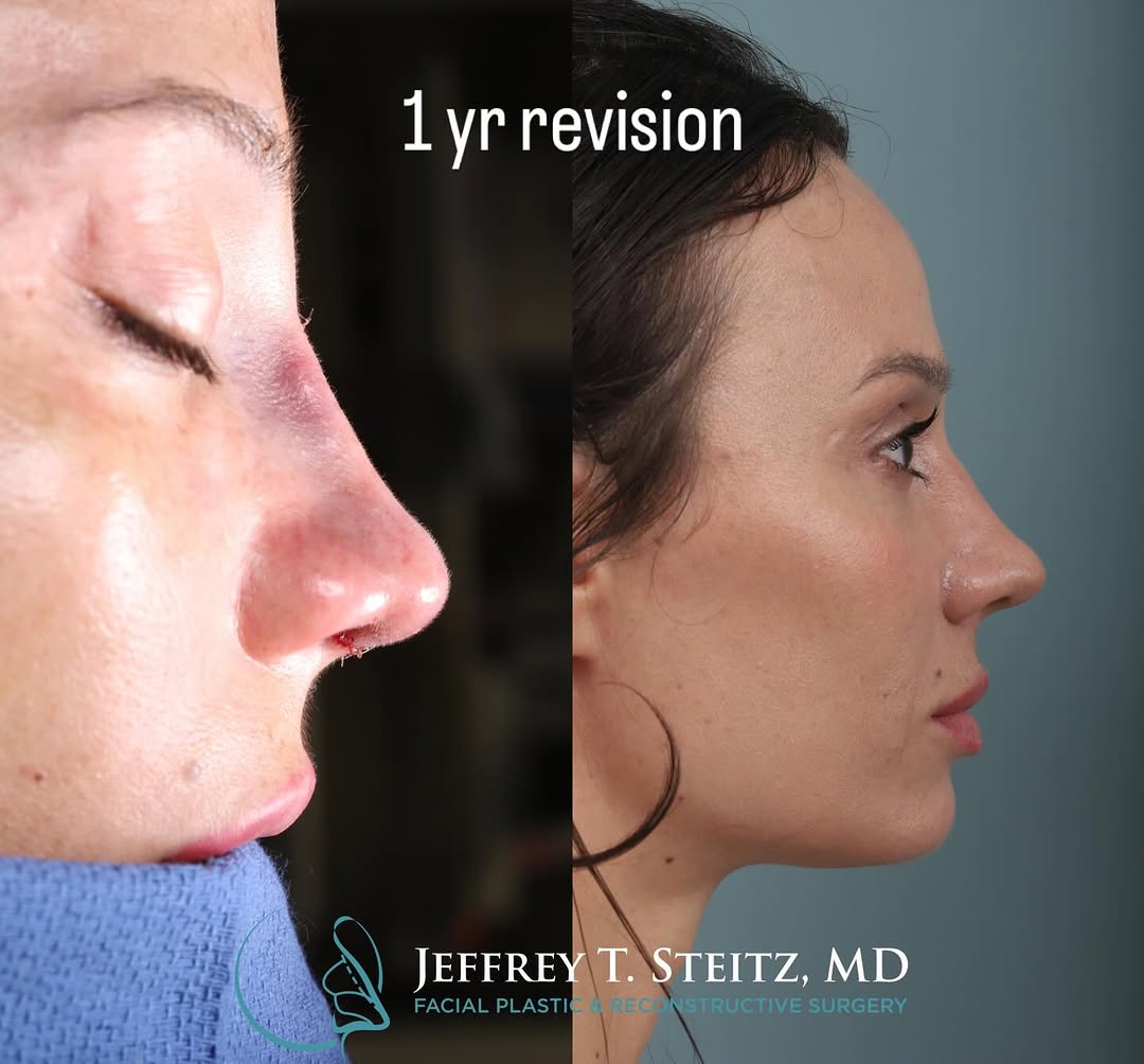 Instagram post by Dr. Jeffrey T. Steitz: Intra-operative photos and long term outcomes. Over the past year or so I stopped posting as many surgical photos. On my end I kind of wonde…