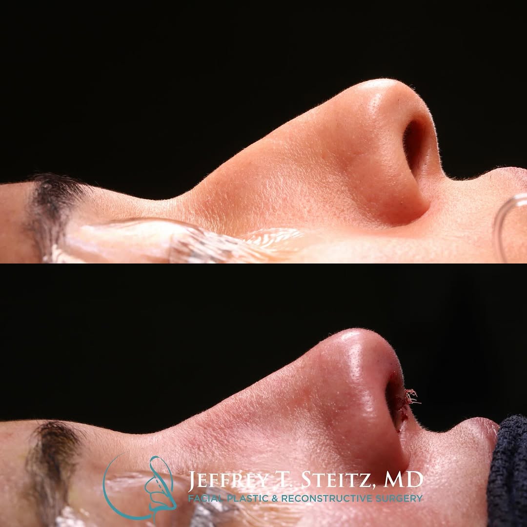 Instagram post by Dr. Jeffrey T. Steitz: Here are a couple intraoperative views from a dorsal preservation case. Techniques used are dorsal preservation hump reduction with subdorsa…