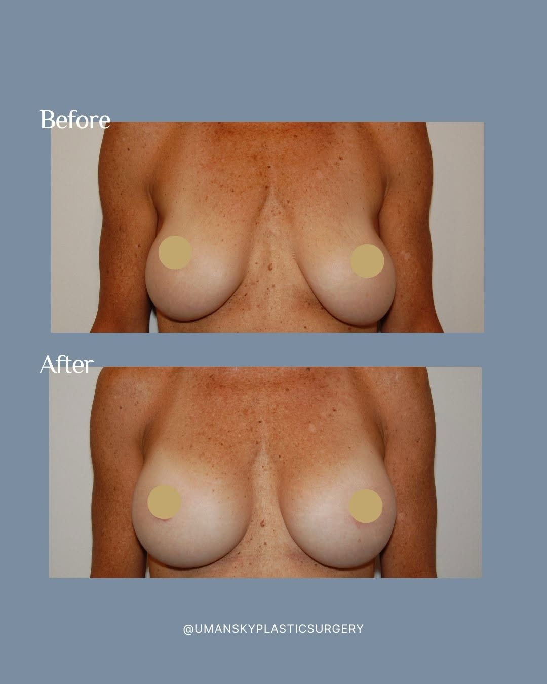 Instagram post by Dr. Jeffrey Umansky: Breast implants don’t have to be a lifelong decision. This 56-year-old patient had saline breast implants placed 20 years ago and was ready …
