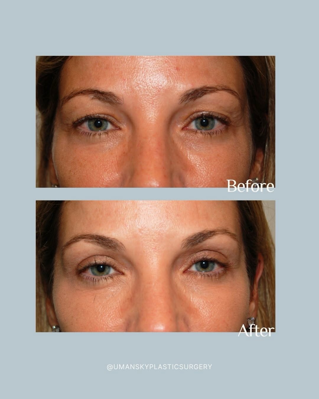 Instagram post by Dr. Jeffrey Umansky: A subtle change can make a meaningful difference. Upper blepharoplasty removes excess skin from the upper eyelids to create a more open, ref…