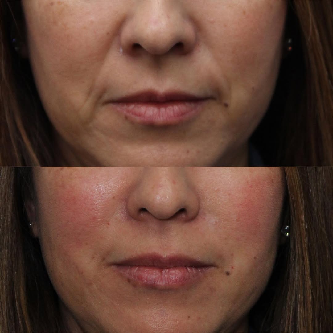 Instagram post by Dr. Jen Yuan Chow: As we age, we lose the “baby fat” in our faces, which can lead to deepening lines and furrows. This volume loss, which includes not only the…