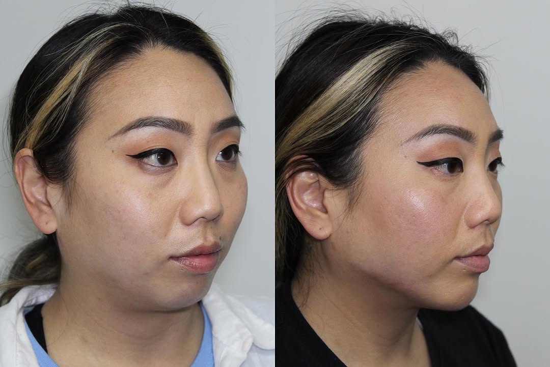 Instagram post by Dr. Jen Yuan Chow: I’m excited to show results for #Volux in the jawline! Juvederm Volux XC is the first and only hyaluronic acid filler that is FDA-approved f…