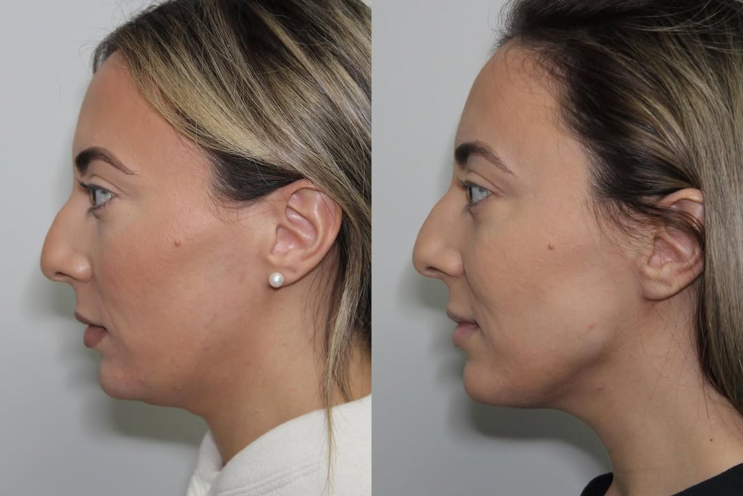 Instagram post by Dr. Jen Yuan Chow: #Volux not only provides definition to poorly defined jawlines; it can also reshape a pre-existing jawline into a more attractive contour ba…