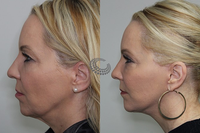 Instagram post by Dr. Jen Yuan Chow: My facelift philosophy has always been to focus on natural results. While creating unnaturally sharp contours can look good on a magazine co…