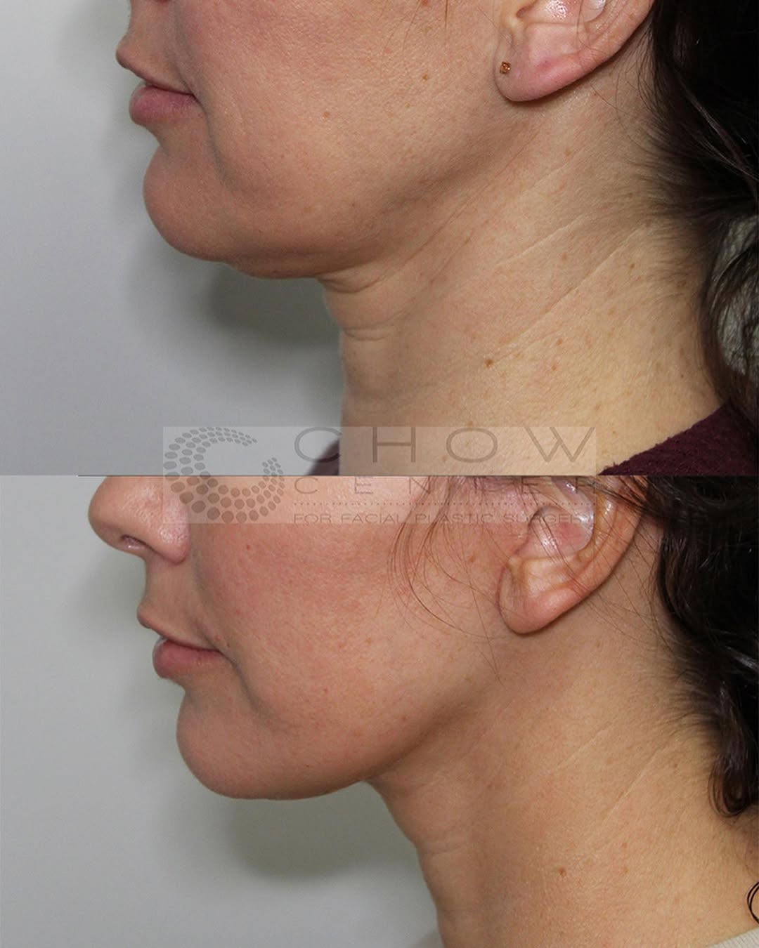 Instagram post by Dr. Jen Yuan Chow: Happy Facelift Follow up Day! This patient of mine wanted to refresh her lower face and neck without changing her natural appearance. Now tw…