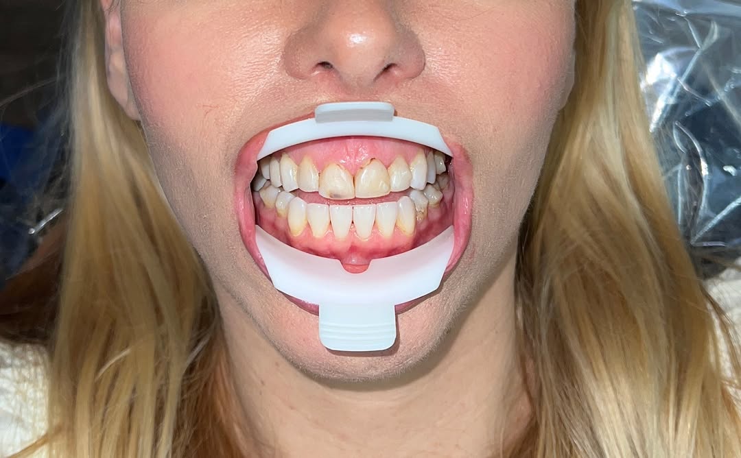 Instagram post by Dr. Jennifer Ebner, DDS: ✨ A healthier, more natural smile thoughtfully designed to support your whole-body wellness. ✨ If damaged or crooked teeth or teeth deeply s…