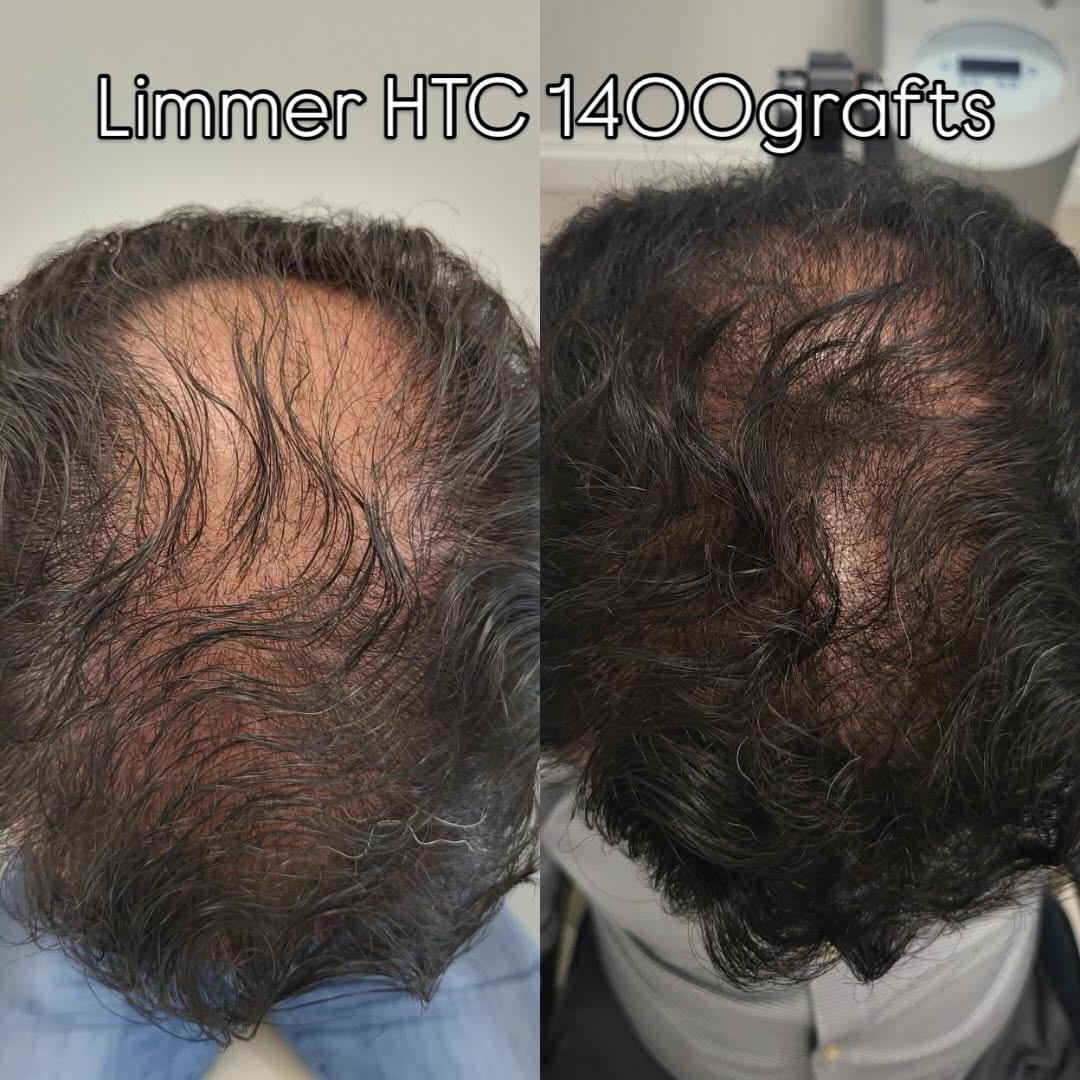 Instagram post by Dr. Jennifer Krejci: Natural results, real confidence. This patient underwent an FUE (Follicular Unit Extraction) procedure with 1,400 grafts harvested and trans…