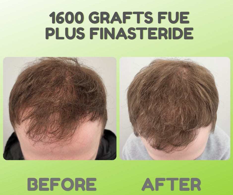 Instagram post by Dr. Jennifer Krejci: At Limmer HTC, we strive to ensure all our patients have the best results in their treatments. This patient is 1 year post-op from an FUE pr…