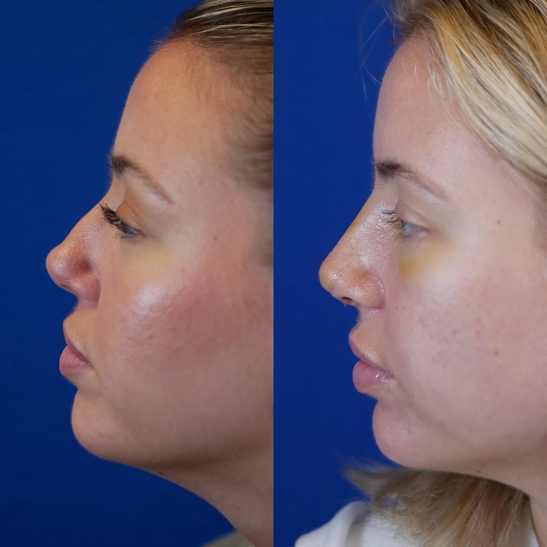 Instagram post by Dr. Jennifer L. Harb: I’m posting this lovely patient for a few reasons- First, this is what a patient looks like one week after surgery, when the nasal packing a…