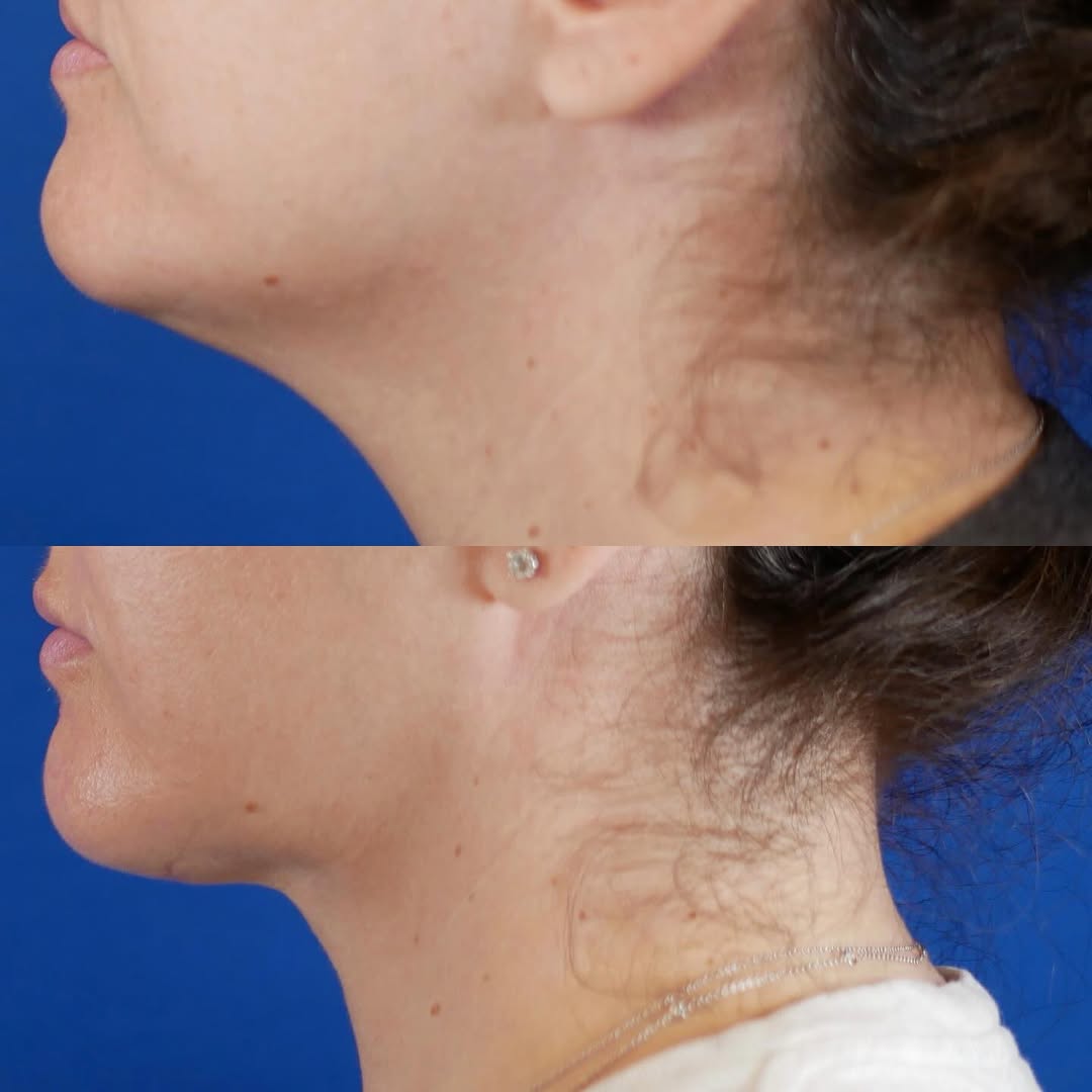 Instagram post by Dr. Jennifer L. Harb: Ummmmm 🤯 hello gorgeous! This patient had recently lost weight and had some excess skin, but also had a naturally fuller neck with some lax…