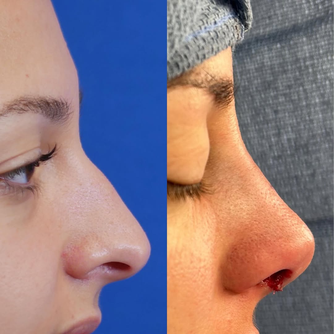Instagram post by Dr. Jennifer L. Harb: On the table results for this lovely patient. She wanted to smooth her dorsal hump and rotate her tip mildly to create a softer profile. As …