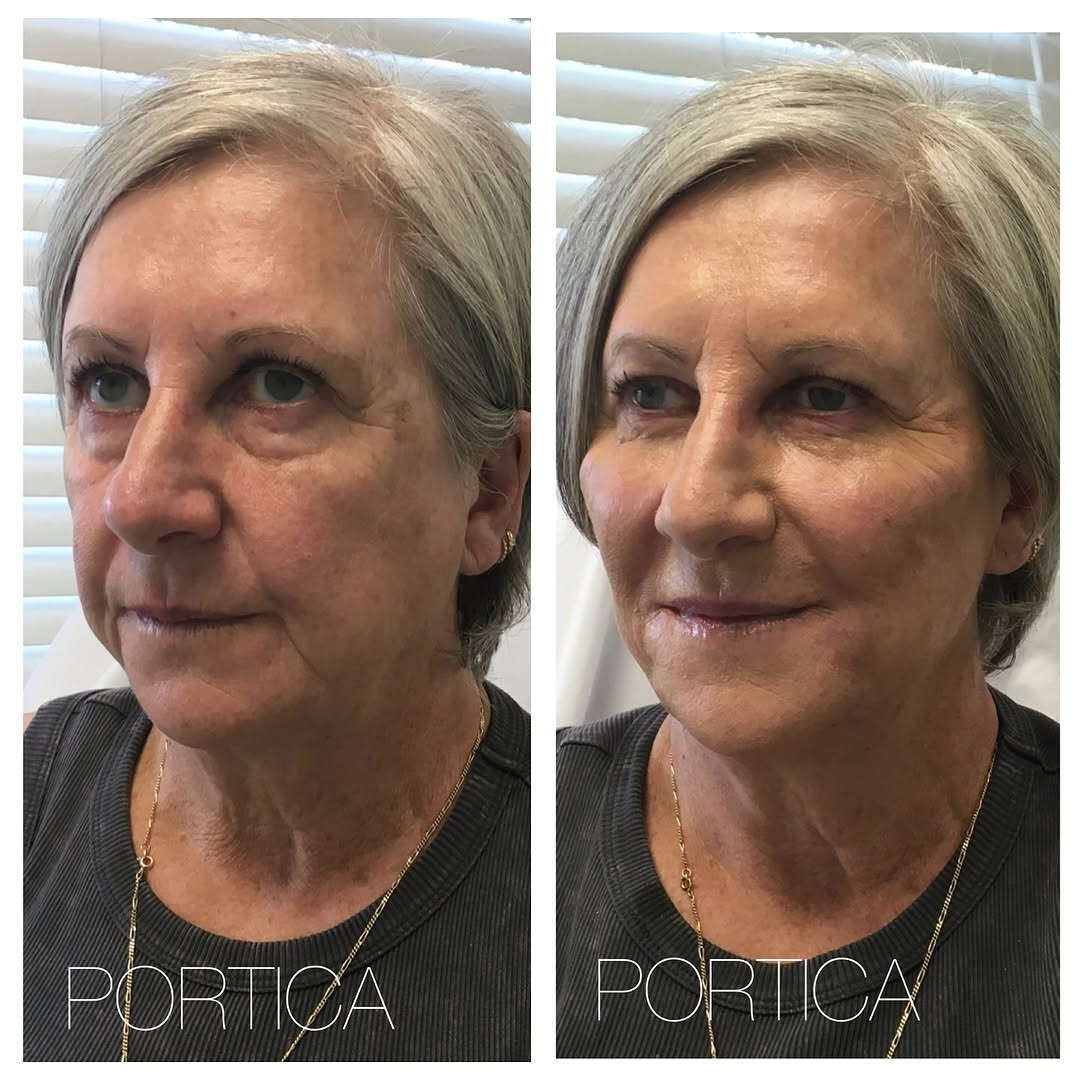 Instagram post by Dr. Jennifer W. Allen: Before and after dermal filler injections to the under-eyes, mid and lower face for this stunning woman. Restoring volume to the midface bri…