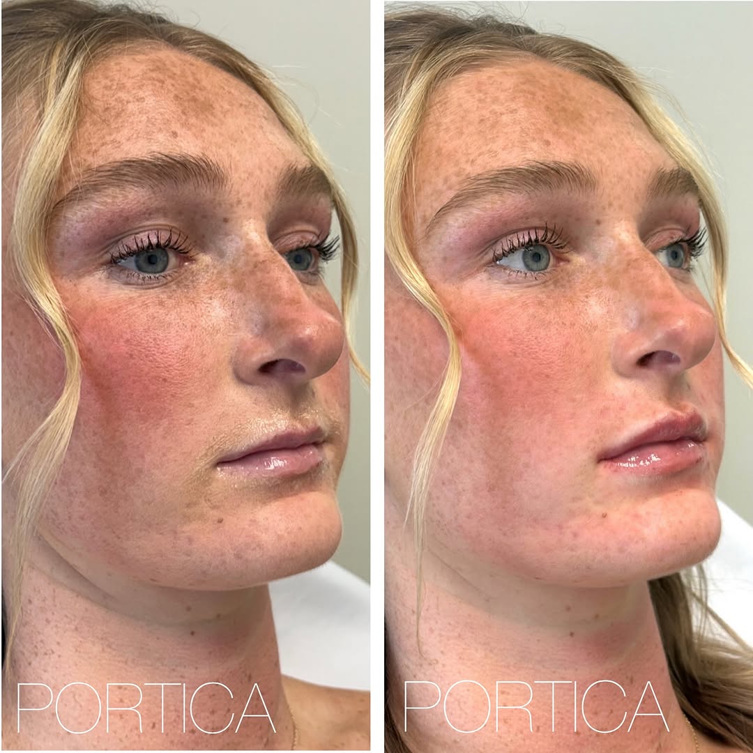 Instagram post by Dr. Jennifer W. Allen: This beautiful college athlete and nursing student was content with her appearance, but opted for a subtle enhancement to achieve natural lo…