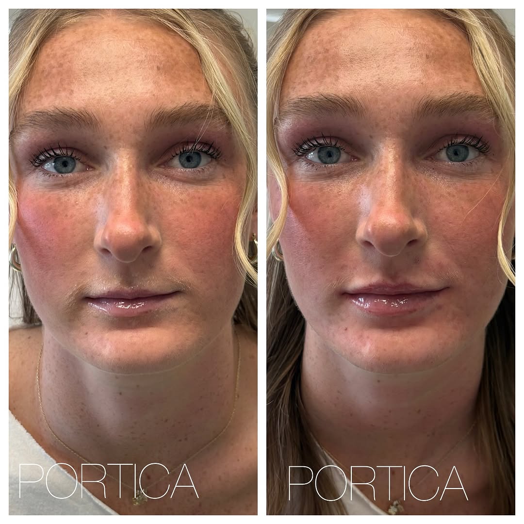 Instagram post by Dr. Jennifer W. Allen: Before and After injection of 3/4 syringe of lip filler for this dynamic young woman who wanted natural looking increased fullness in her li…