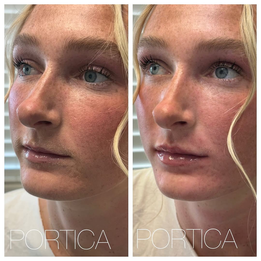 Instagram post by Dr. Jennifer W. Allen: Subtle, soft, and natural. Just a touch of volume to enhance her already beautiful lips 💕