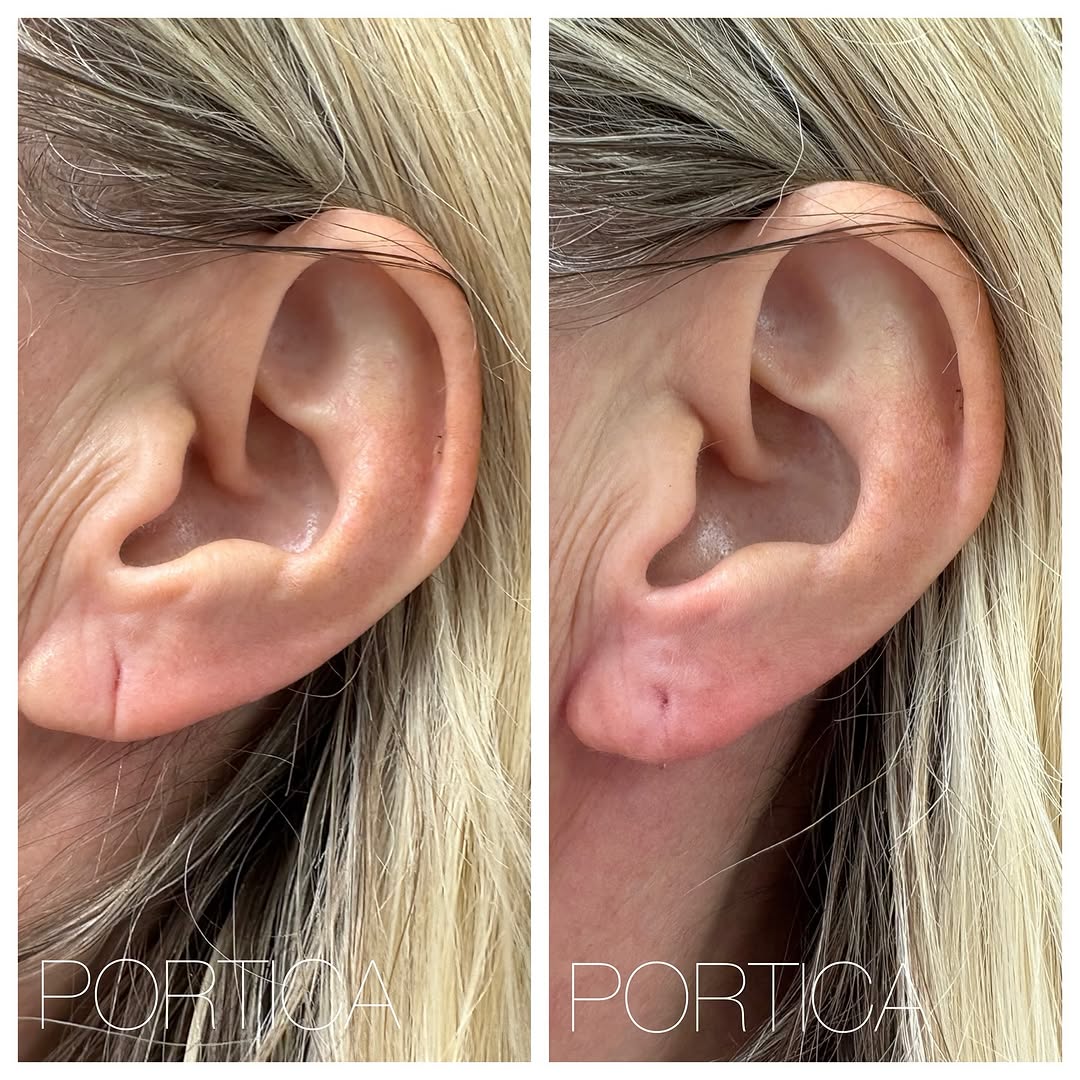 Instagram post by Dr. Jennifer W. Allen: Before and After injection of earlobe with dermal filler to restore youthful structure and better support the weight of ear rings. Injection…
