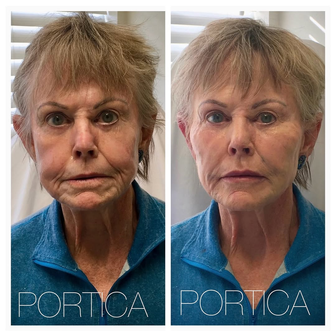 Instagram post by Dr. Jennifer W. Allen: Before & Immediately After ✨ Dermal filler treatment for this witty, kind, and intelligent retired college professor who’s prepping for her …