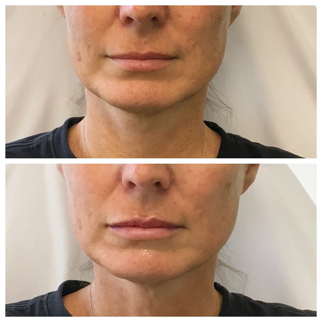 Instagram post by Dr. Jennifer W. Allen: Before and After lip filler for this beautiful soul who wanted just a bit more volume over all and a more defined and noticeable upper lip. …