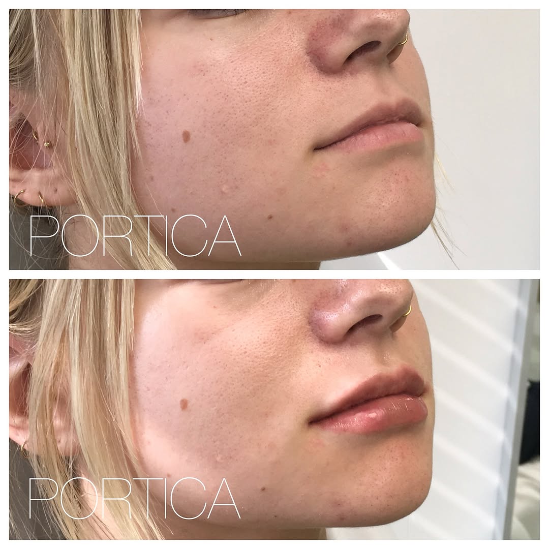 Instagram post by Dr. Jennifer W. Allen: This hardworking medical student was happy with her appearance and lip shape but wanted increased volume and a more visible upper lip when s…