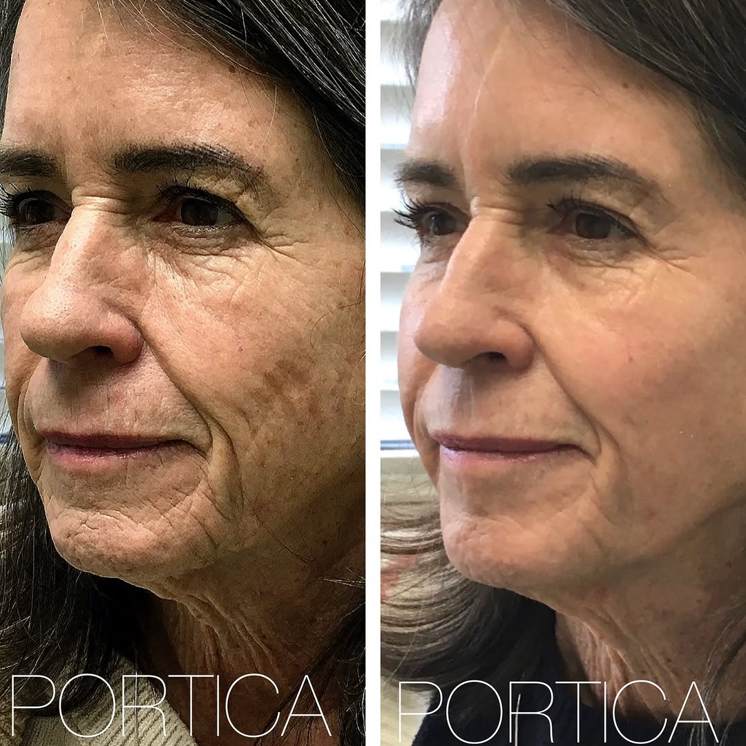 Instagram post by Dr. Jennifer W. Allen: Fractional CO₂ Laser Resurfacing — Before and 1 Month Post Treatment The results show improvement in skin texture, dyspigmentation, and fine…