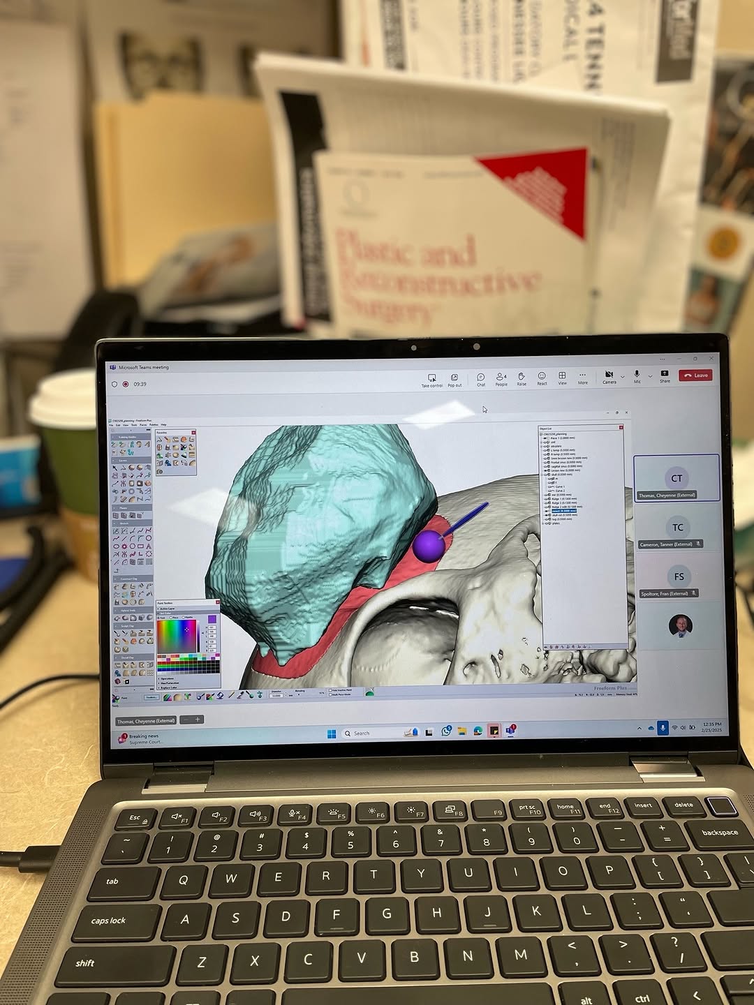 Instagram post by Dr. Jeremy Powers: 🌟 Virtual Surgical Planning: Where innovation meets precision in craniofacial surgery! 🖥️💀 One of the things I love most about my job is …