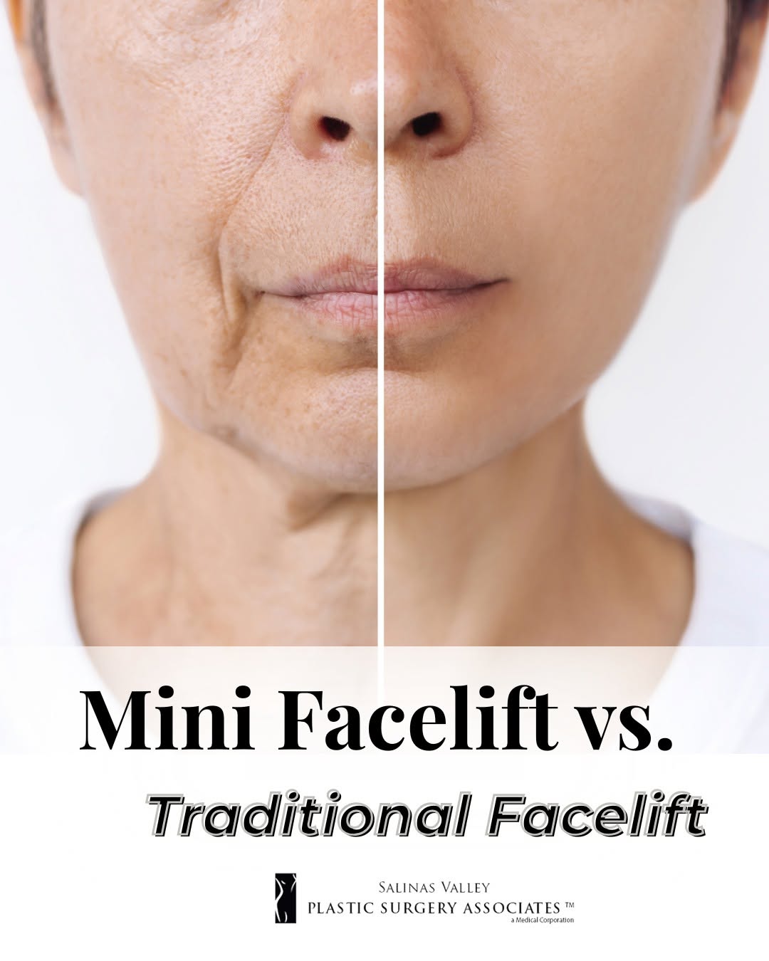 Instagram post by Dr. Jeremy Silk: Not sure which option is right for you? A Mini Facelift targets early signs of aging with subtle lifting and refreshed definition, plus less…