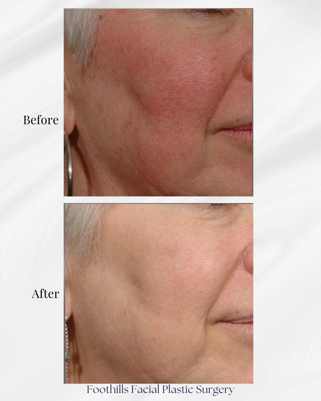 Instagram post by Dr. Jerold Olson: Struggling with redness or rosacea? IPL (Intense Pulsed Light) might be the solution. ✨ This non-invasive treatment targets visible blood ve…
