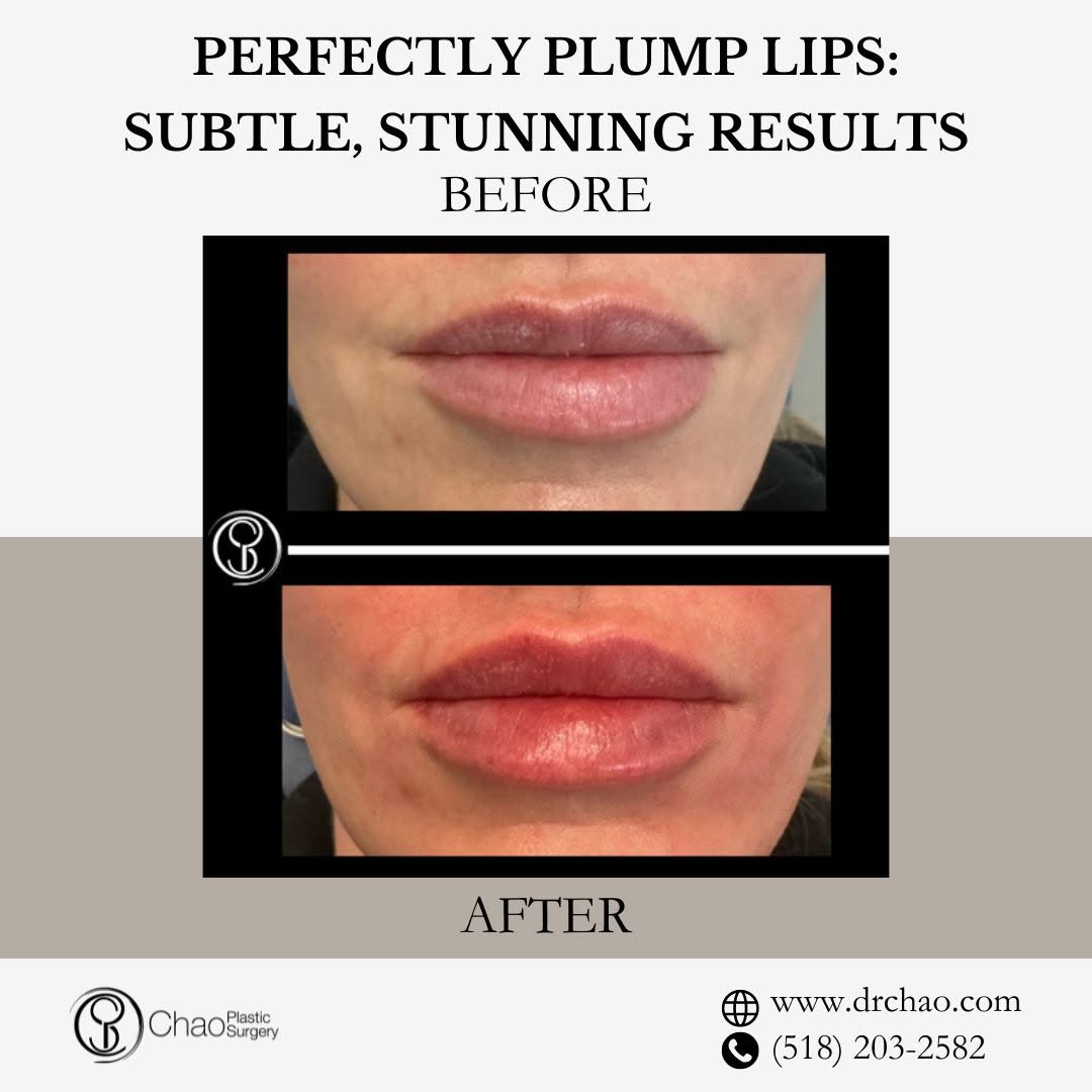 Instagram post by Dr. Jerome D. Chao: Fuller lips don't have to mean an overdone look. Lip injections can be customized to enhance shape, restore volume, and create better balanc…