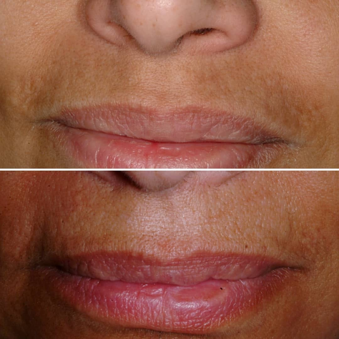 Instagram post by Dr. Jerome M. Garden: Melasma, a common hyperpigmentation condition, can be difficult to treat. Lasers, along with strict sun protection, can result in great resu…