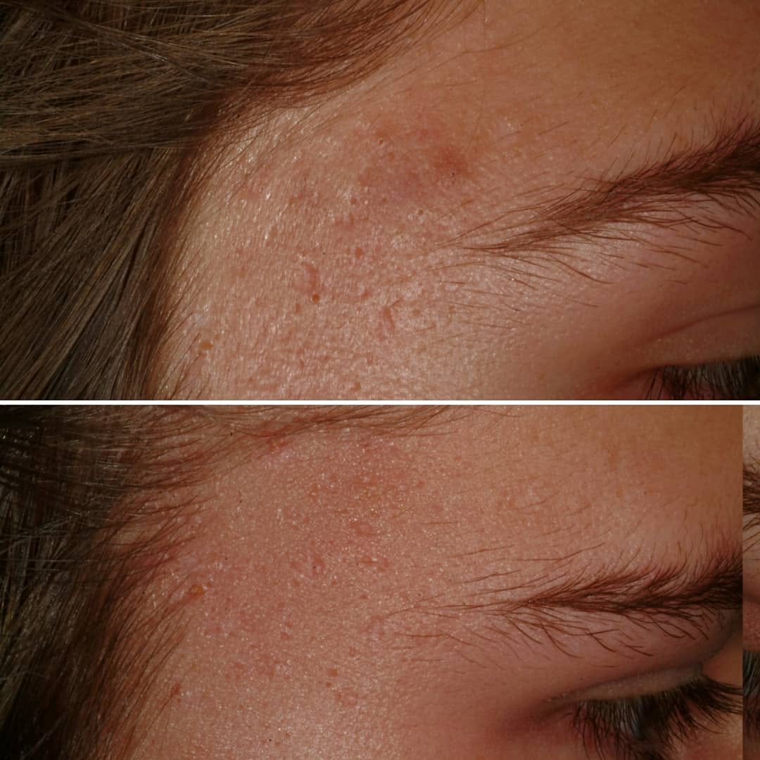 Instagram post by Dr. Jerome M. Garden: Acne scarring can be emotionally challenging for patients. Luckily, using advanced laser technology and careful technique, we can greatly im…