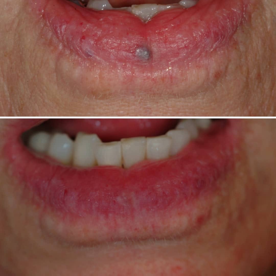 Instagram post by Dr. Jerome M. Garden: Venous lakes are fun to treat! These enlarged blood vessels typically appear on the lower lip in middle age. One or two treatments with a va…