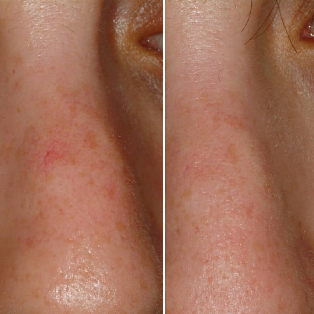 Instagram post by Dr. Jerome M. Garden: Something as small as a few enlarged blood vessels on the nose can greatly bother a patient and make them self-conscious. These vessels can …