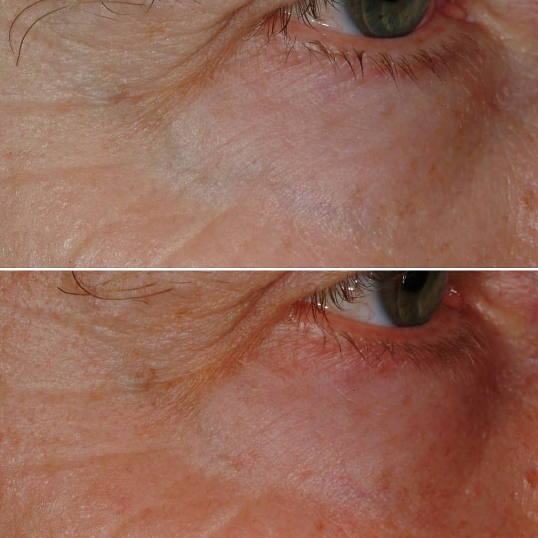 Instagram post by Dr. Jerome M. Garden: Large blue veins near the eyes, called periorbital veins, are common. These need to be treated very carefully given the proximity to the eye…