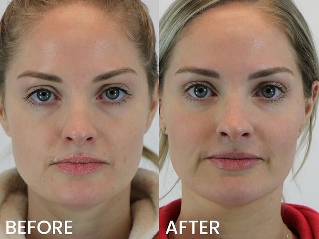 Instagram post by Dr. Jerry Darm: The best kind of filler treatments are the ones where you can’t quite tell what a person got done, but they’re looking beautiful, natural an…