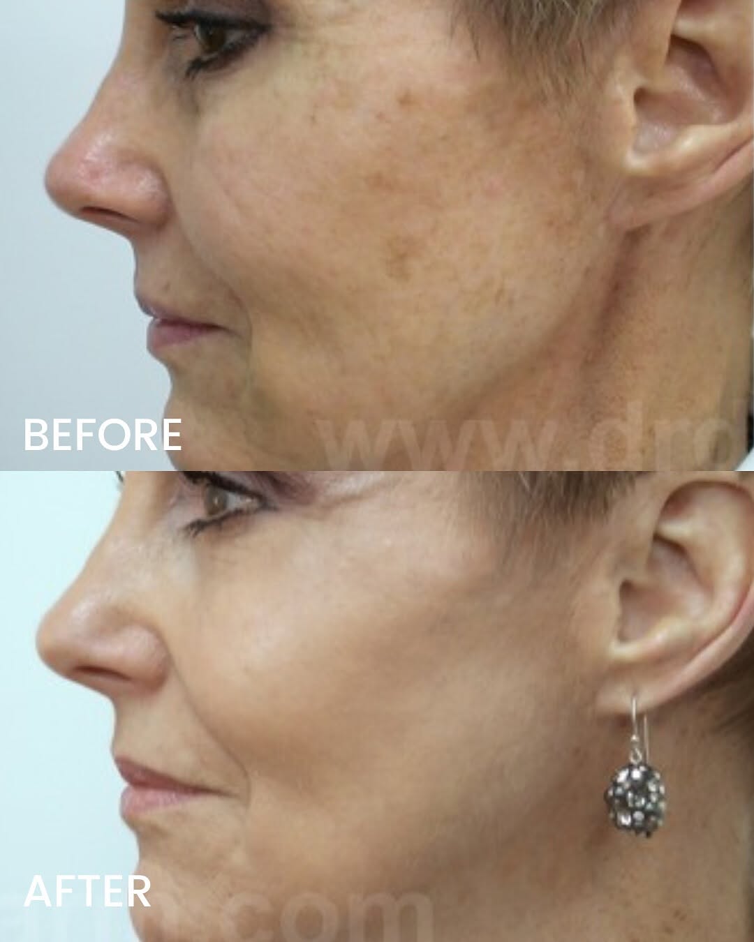 Instagram post by Dr. Jerry Darm: Take years off your skin with LaserLift™! ✨ As we age, the skin, collagen, and elastin can be damaged by the sun, smoking, free radicals, an…