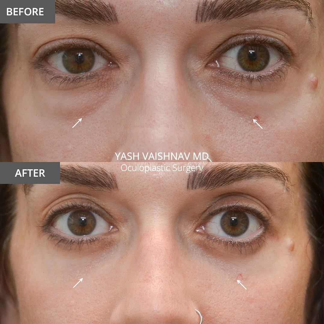 Instagram post by Dr. Jerry Popham: 6️⃣ weeks after lower eyelid surgery to address under-eye bags. If you think you look tired, let’s change that. 📍 Denver, CO | Dr. Yash Vai…