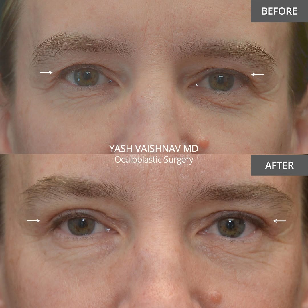 Instagram post by Dr. Jerry Popham: 2️⃣ months after upper eyelid surgery. If you didn’t know she had surgery, you’d just think she slept well. Subtlety is the goal. 📍 Denver,…
