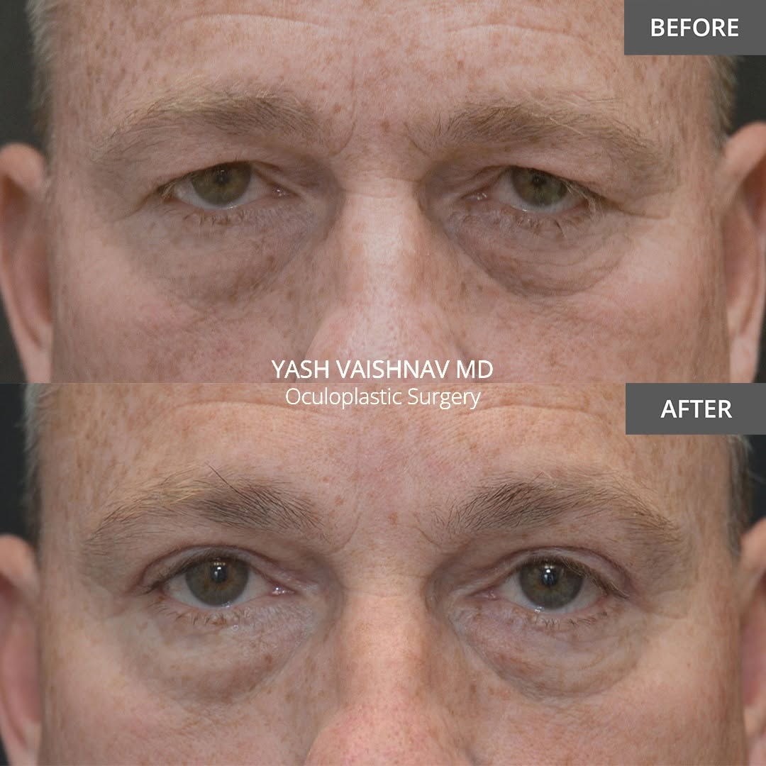 Instagram post by Dr. Jerry Popham: Male upper eyelid surgery takes a different touch. He’s 4️⃣ months out and looks like himself… just less tired. Swipe to the last slide to s…