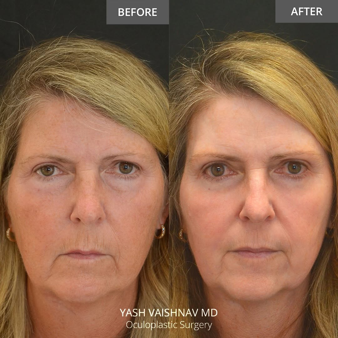 Instagram post by Dr. Jerry Popham: 8️⃣ weeks out from brow lift, right eyelid lift, lower blepharoplasty—combined with deep erbium laser skin resurfacing. Swipe to see how the…
