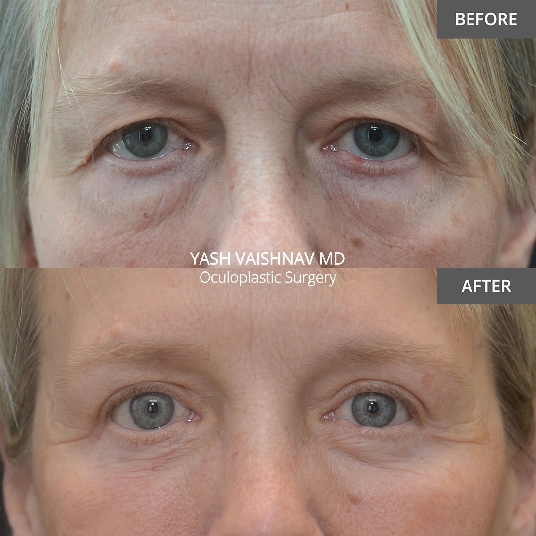 Instagram post by Dr. Jerry Popham: 6️⃣ months after upper + lower eyelid surgery — the incisions are barely visible. Her reaction on the last slide is why I do this. 📍 Denver…