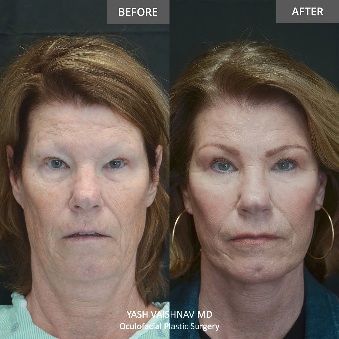 Instagram post by Dr. Jerry Popham: Upper/lower blepharoplasty, facelift, and neck lift — 6 months out. People get their teeth cleaned, buy nice clothes — investing in your fac…