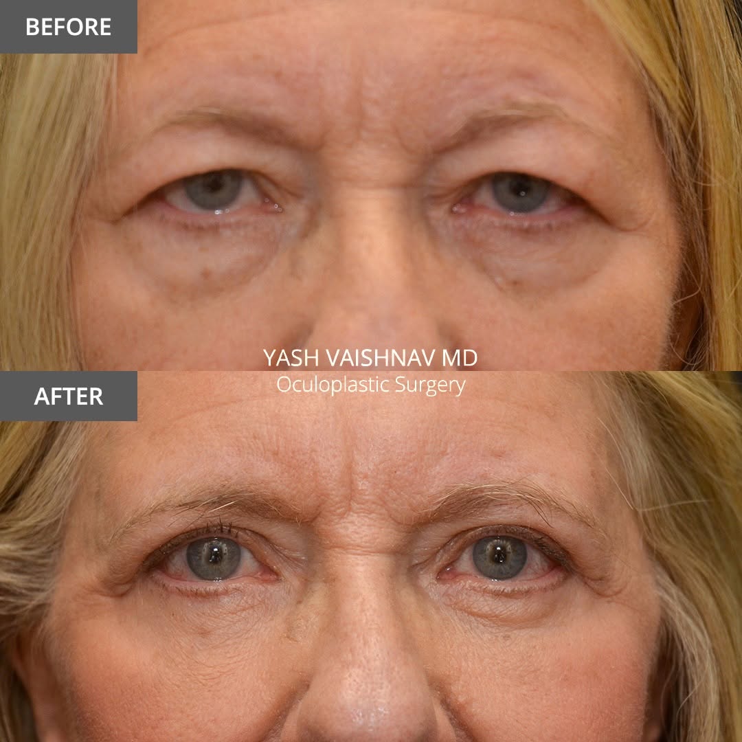 Instagram post by Dr. Jerry Popham: 6️⃣ months after upper and lower blepharoplasty with fat transposition. Natural eyelid contour, zero hollowing. . . . . . . #beforeandafter …
