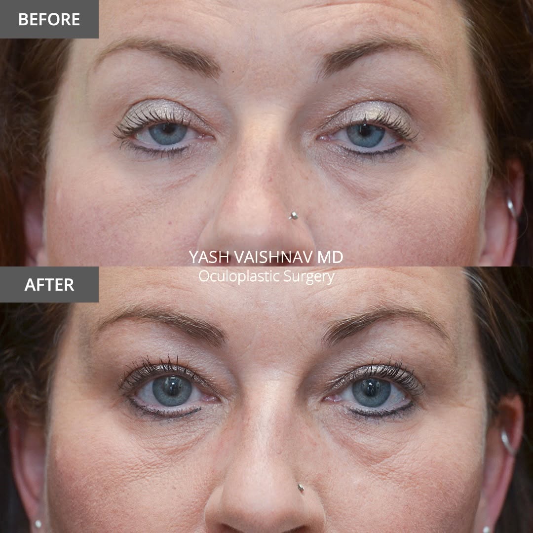 Instagram post by Dr. Jerry Popham: 2️⃣ months after upper eyelid lift. No skin incision. Just more awake. 📍 Denver, CO | Dr. Yash Vaishnav 📞 303-468-8844 . . . . . . #Eyelid…