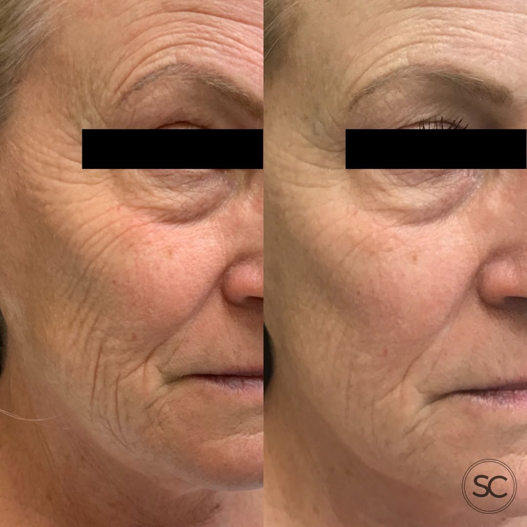 Instagram post by Dr. Jessica K. Anderson, N: microneedling is for you if… 👀 your skin has ✨potential✨ but needs a little push. acne scars? texture? fine lines? big pores? sun damage? s…
