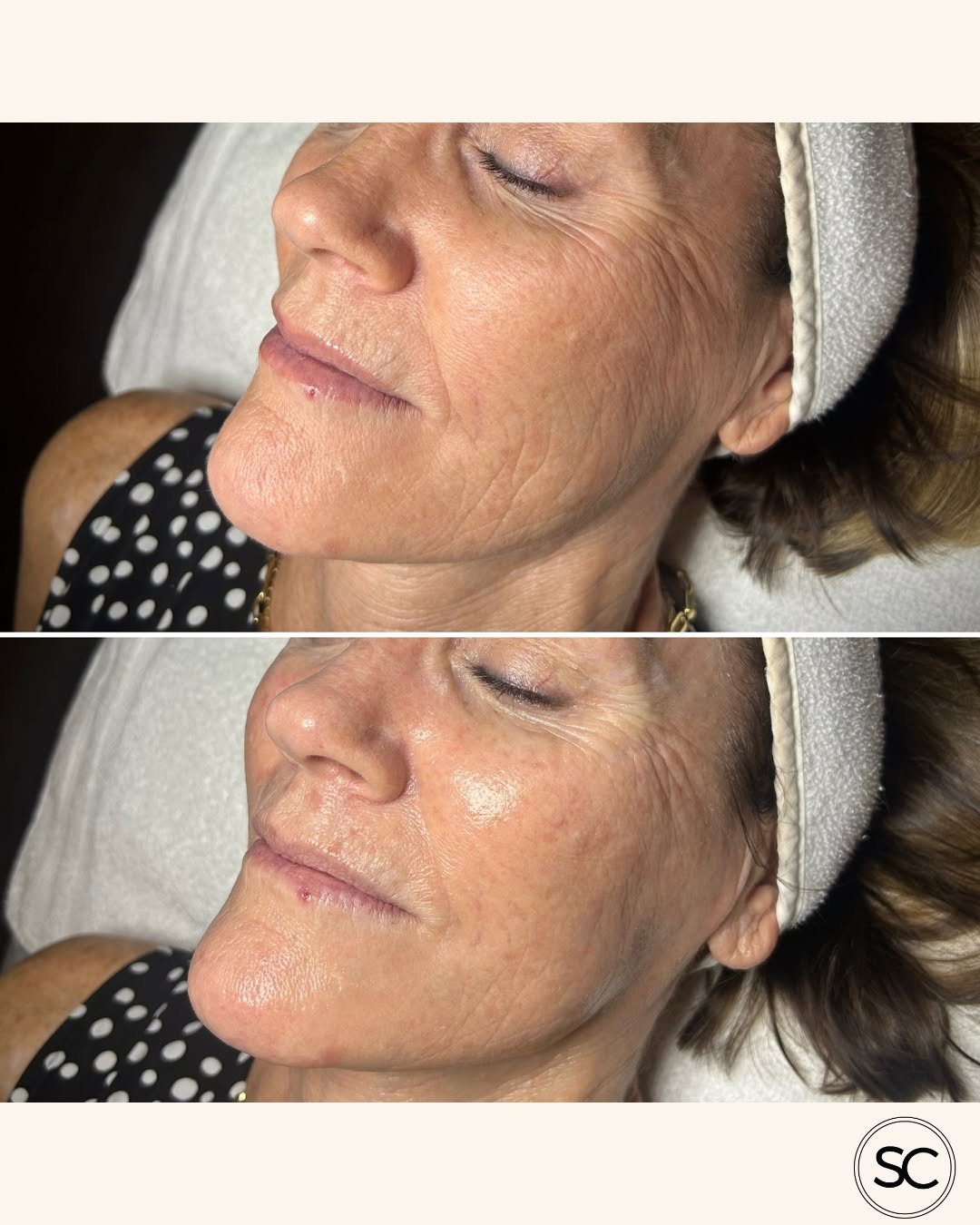 Instagram post by Dr. Jessica K. Anderson, N: A facial that feels as good as it looks ✨ DiamondGlow + Dermaplane is the perfect combination of relaxation + skin-enhancing results. 🤍 Dia…