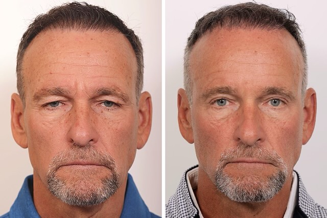 Instagram post by Dr. Jessica Lattman: 6 months post-op upper lid blepharoplasty and endoscopic brow lift. Our patient is thrilled and feeling refreshed with 100% natural result.